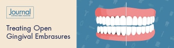 CDA Journal July research collection on treating open gingival embrasures